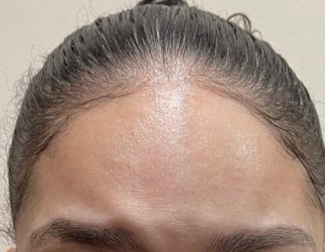 Botox after 1