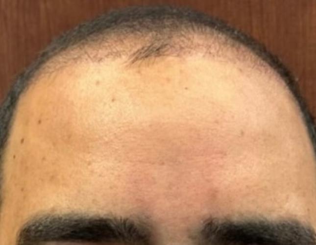 Botox after 2