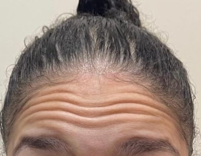 Botox before 1
