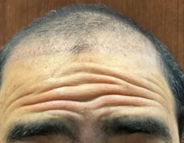 Botox before 2