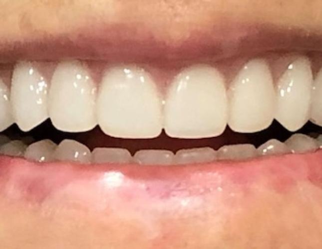 Dentures after