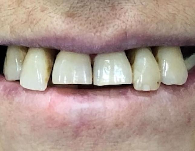 Dentures before