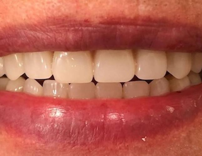 Implants after 2