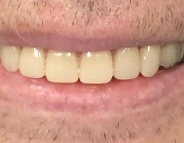 Implants after 1