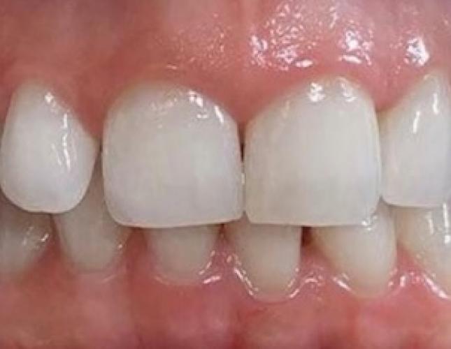 Whitening after 2