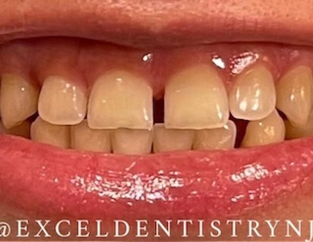 Whitening before 1