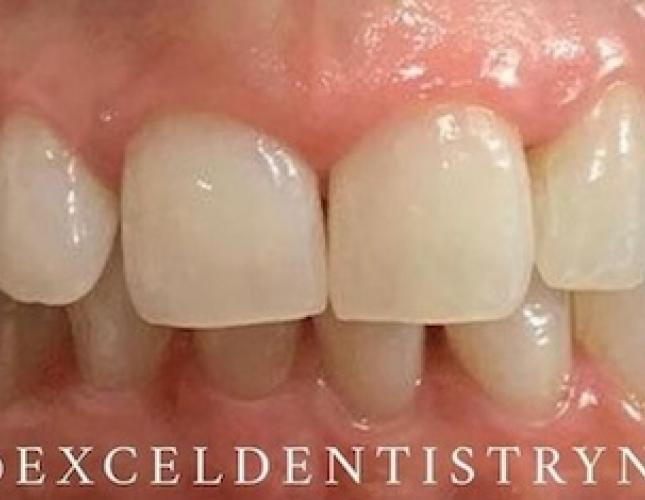 Whitening before 1